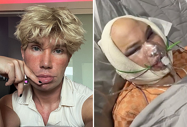 Hvězda Big Brotheru ukázala drastické následky plastiky. Fanoušci byli v šoku